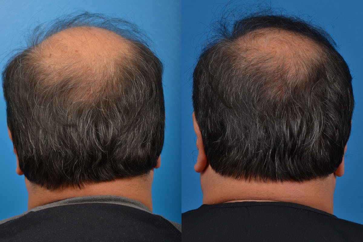 Hair Restoration Before & After Gallery - Patient 122405272 - Image 2