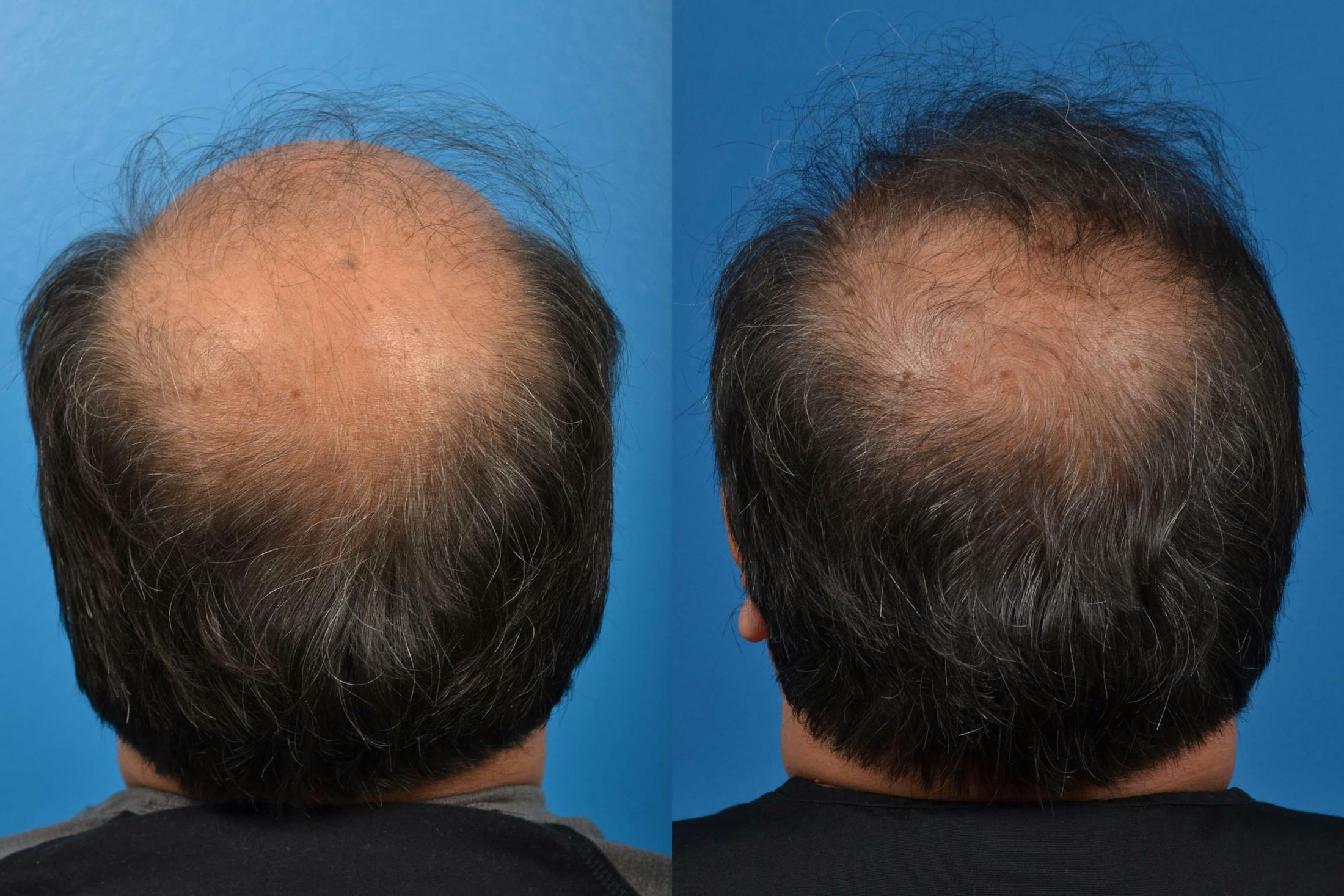 Hair Restoration Before & After Gallery - Patient 122405272 - Image 3
