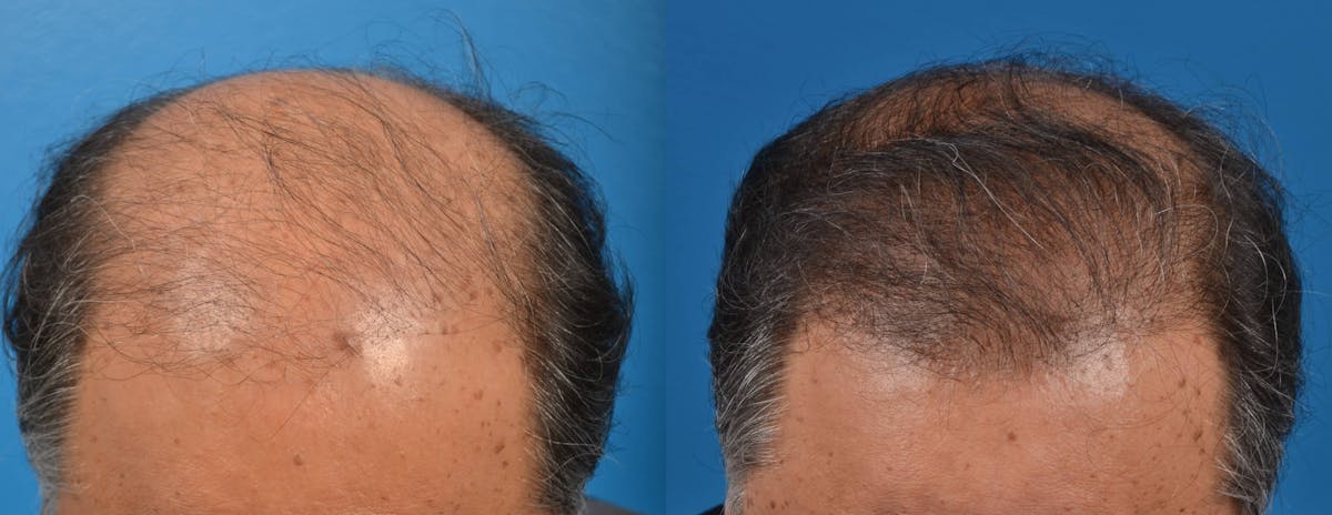 Hair Restoration Before & After Gallery - Patient 122405272 - Image 4