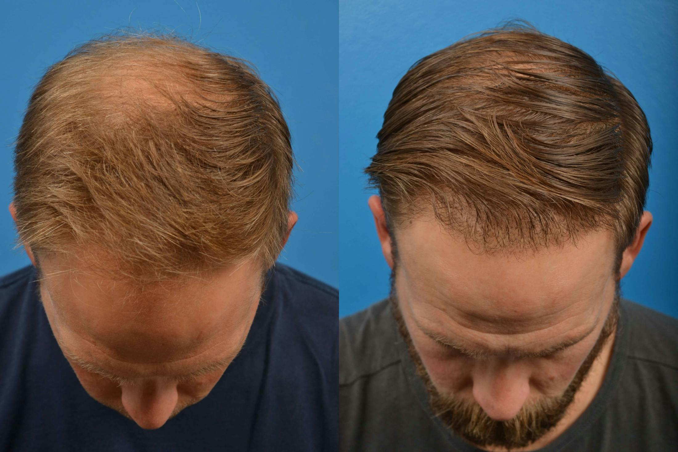 Hair Restoration Before & After Gallery - Patient 122405274 - Image 1