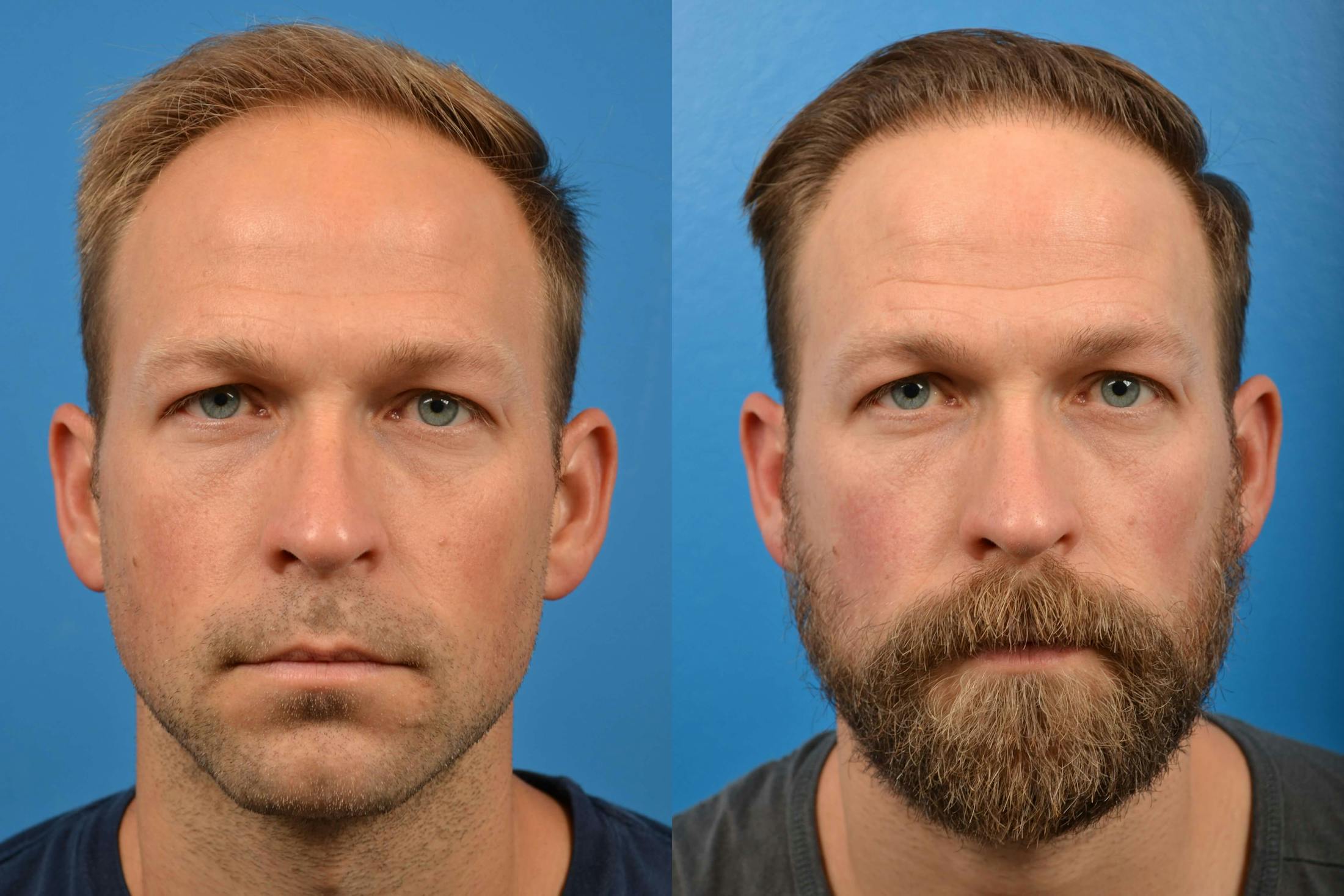 Hair Restoration Before & After Gallery - Patient 122405274 - Image 2