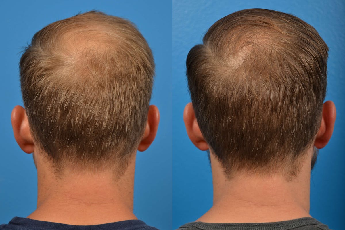 Hair Restoration Before & After Gallery - Patient 122405274 - Image 3