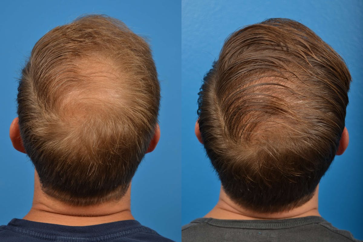 Hair Restoration Before & After Gallery - Patient 122405274 - Image 4