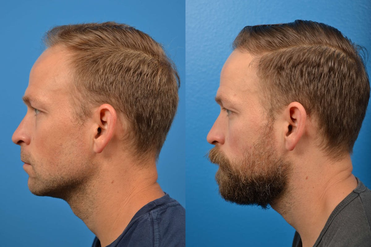 Hair Restoration Before & After Gallery - Patient 122405274 - Image 5