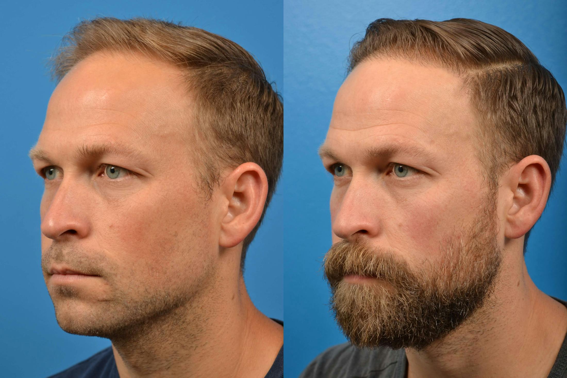 Hair Restoration Before & After Gallery - Patient 122405274 - Image 6