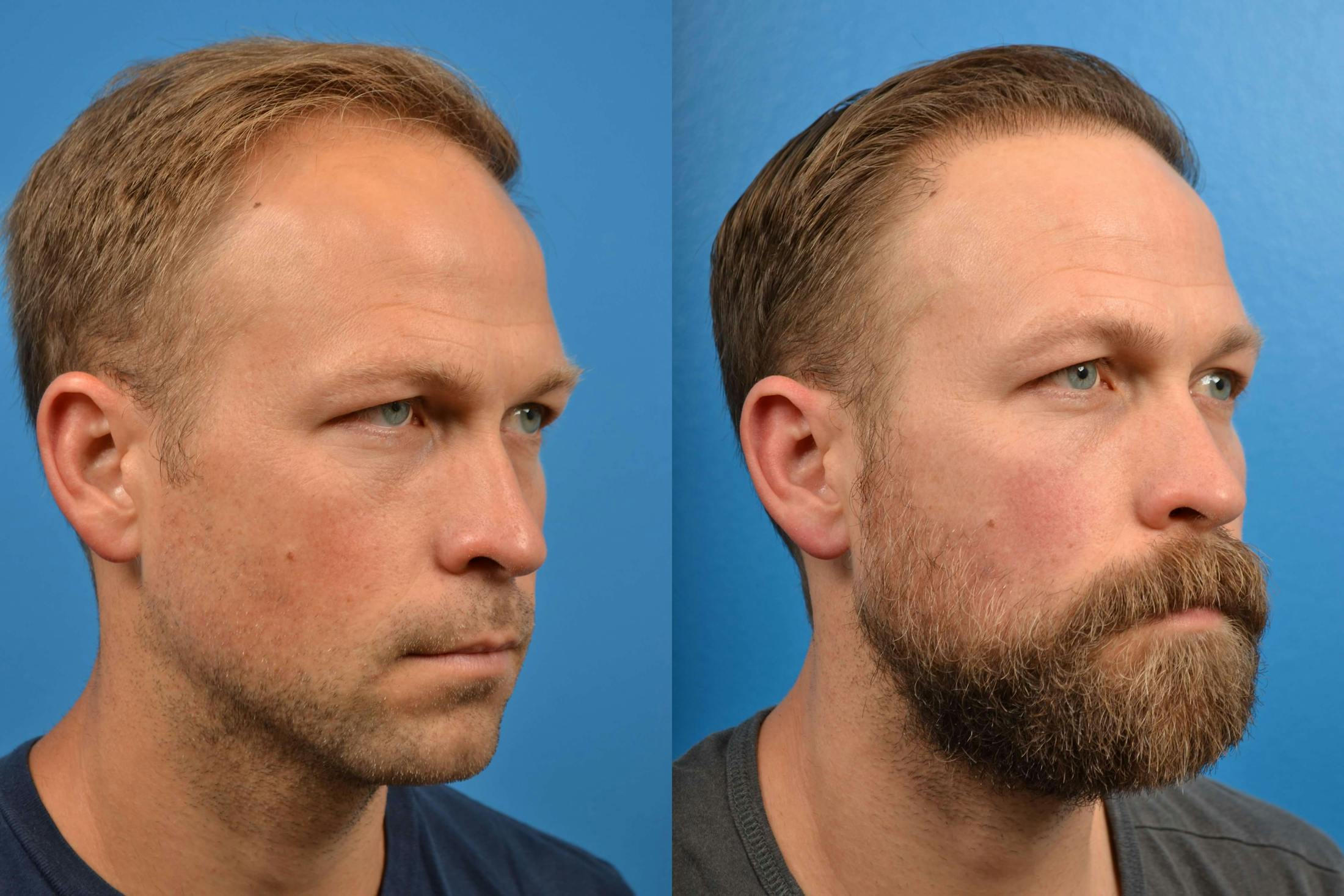 Hair Restoration Before & After Gallery - Patient 122405274 - Image 7