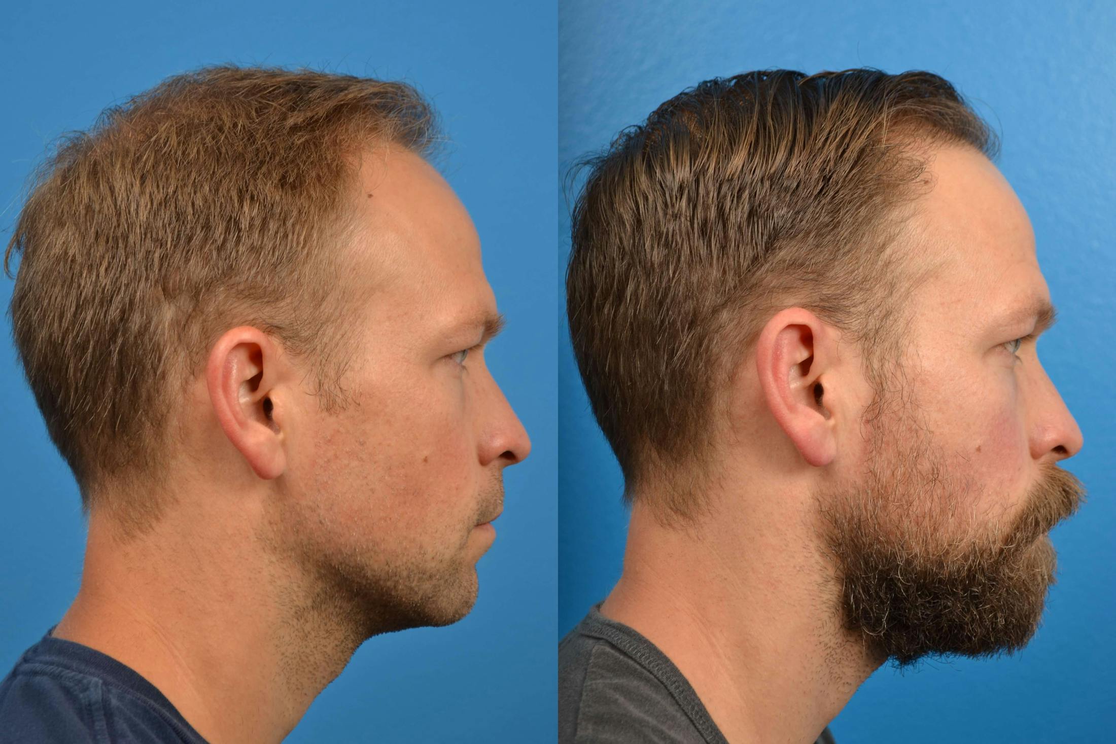 Hair Restoration Before & After Gallery - Patient 122405274 - Image 8