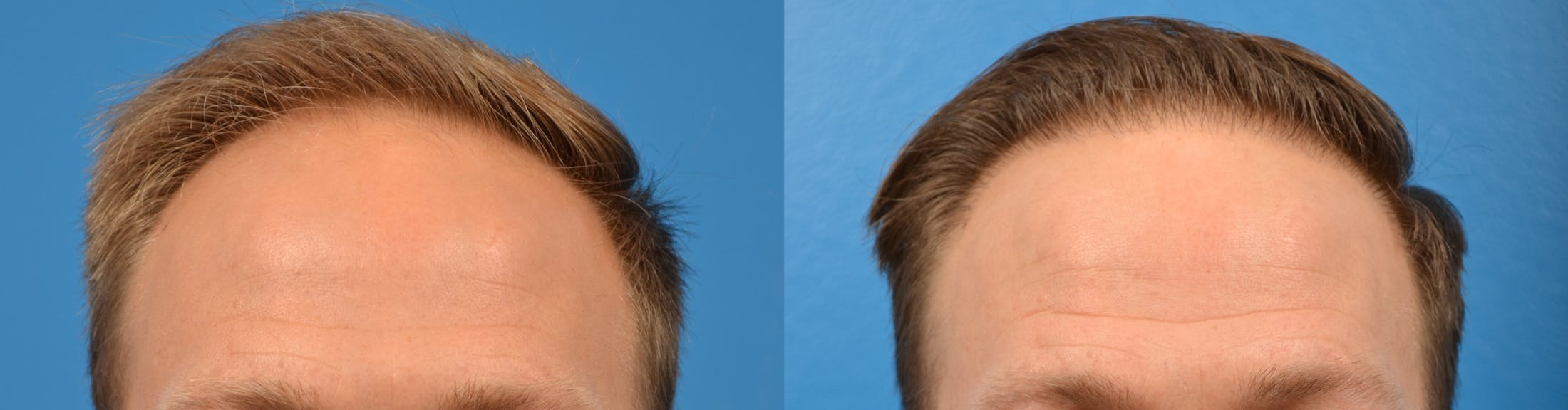 Hair Restoration Before & After Gallery - Patient 122405274 - Image 9
