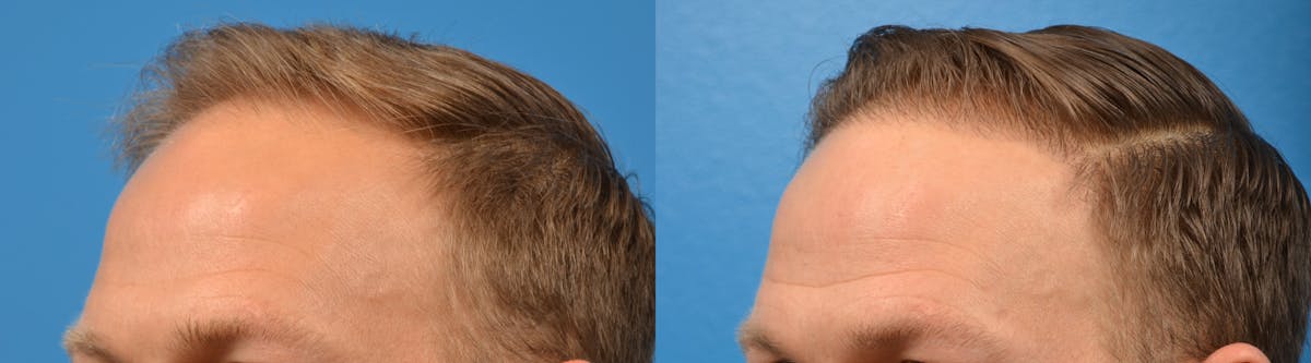 Hair Restoration Before & After Gallery - Patient 122405274 - Image 10