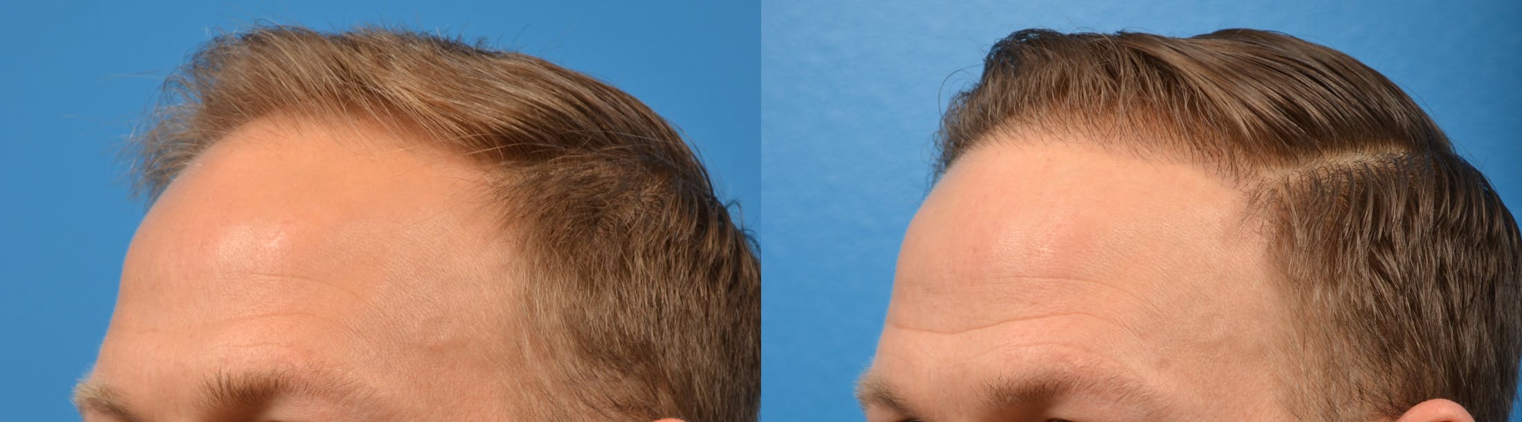 Hair Restoration Before & After Gallery - Patient 122405274 - Image 10