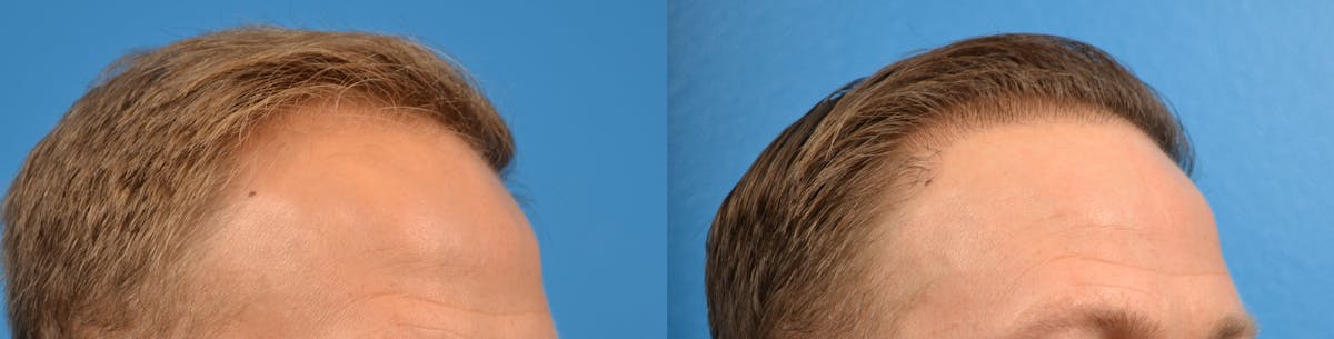 Hair Restoration Before & After Gallery - Patient 122405274 - Image 11
