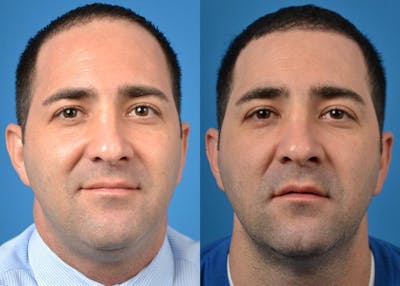 Hair Restoration Before & After Gallery - Patient 122405275 - Image 1