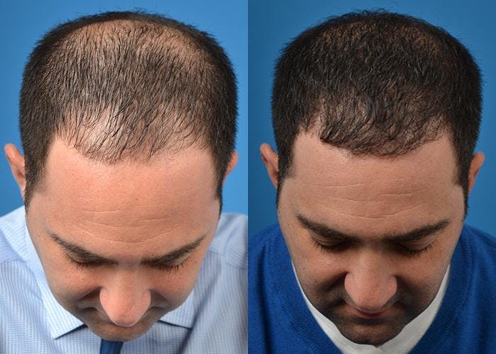 Hair Restoration Before & After Gallery - Patient 122405275 - Image 2