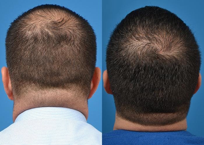 Hair Restoration Before & After Gallery - Patient 122405275 - Image 3