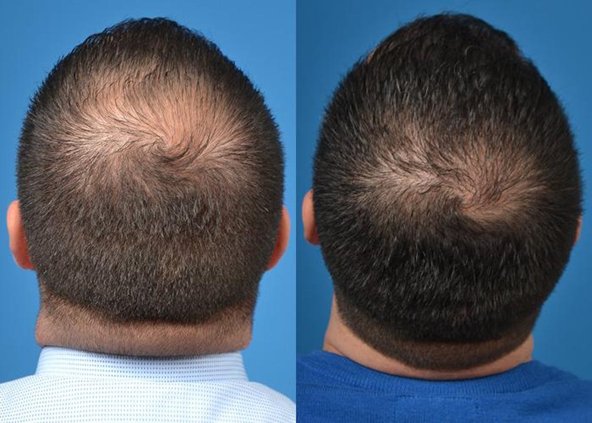 Hair Restoration Before & After Gallery - Patient 122405275 - Image 4