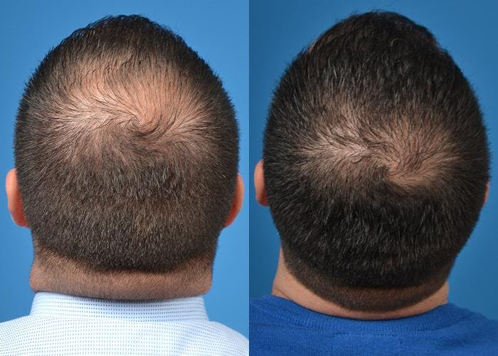 Hair Restoration Before & After Gallery - Patient 122405275 - Image 4