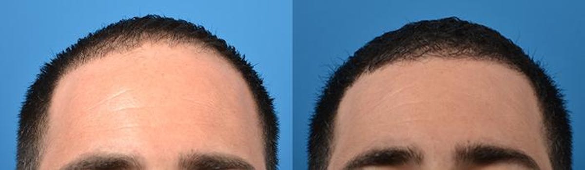 Hair Restoration Before & After Gallery - Patient 122405275 - Image 5