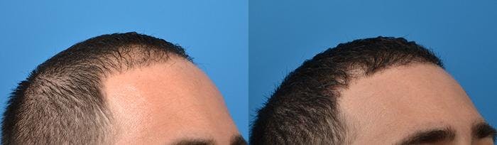 Hair Restoration Before & After Gallery - Patient 122405275 - Image 6