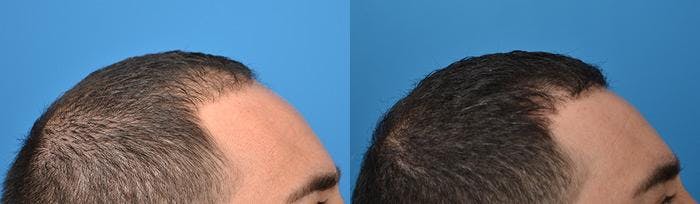 Hair Restoration Before & After Gallery - Patient 122405275 - Image 7