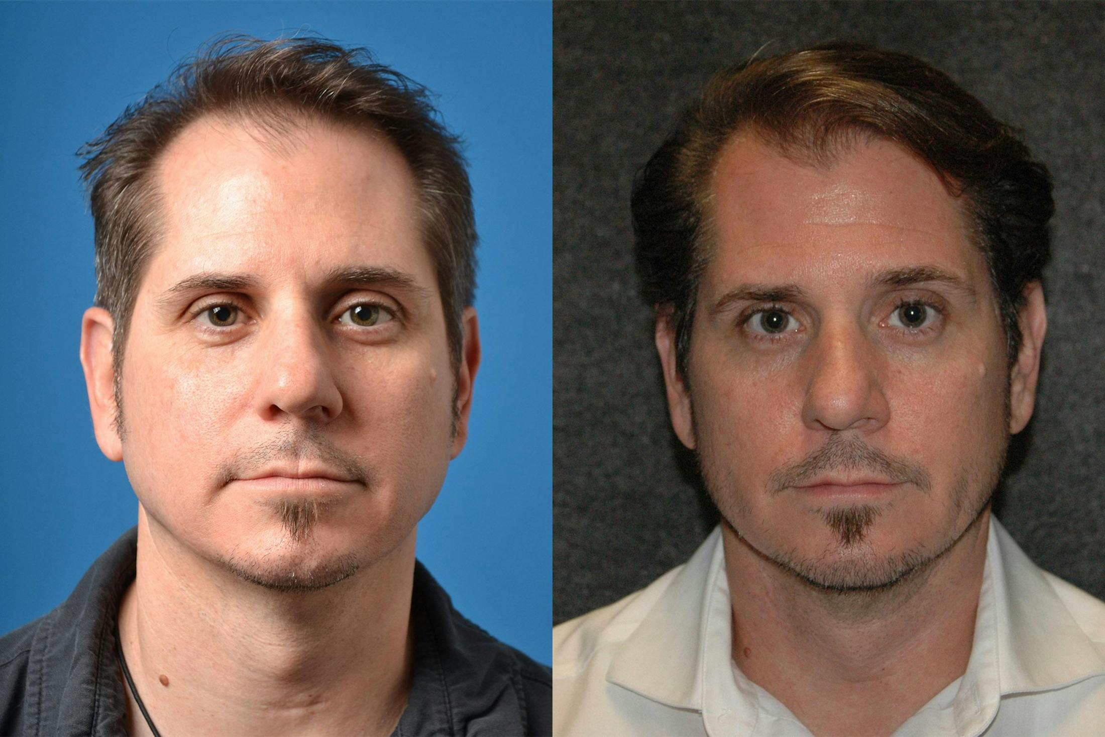 Hair Restoration Before & After Gallery - Patient 122405276 - Image 1