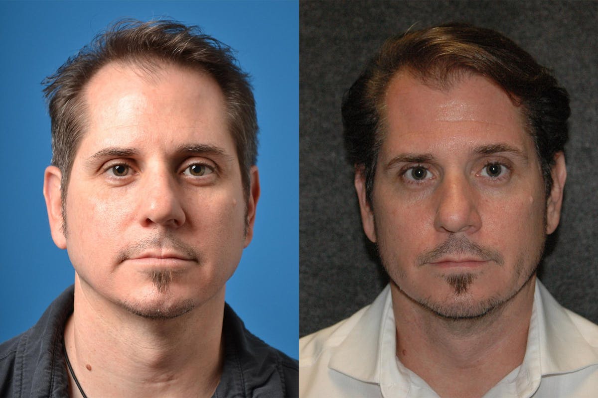 Hair Restoration Before & After Gallery - Patient 122405276 - Image 1
