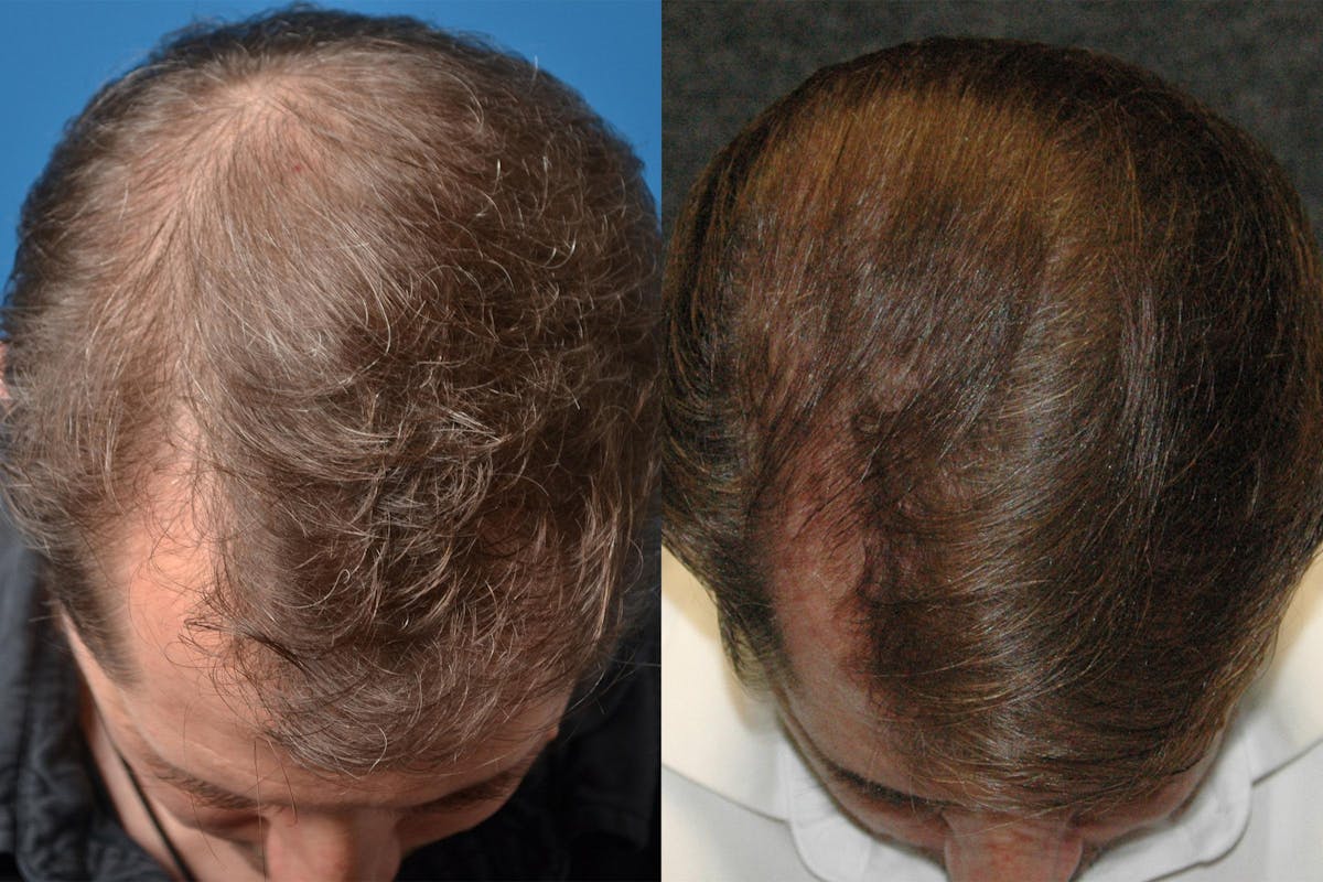 Hair Restoration Before & After Gallery - Patient 122405276 - Image 2