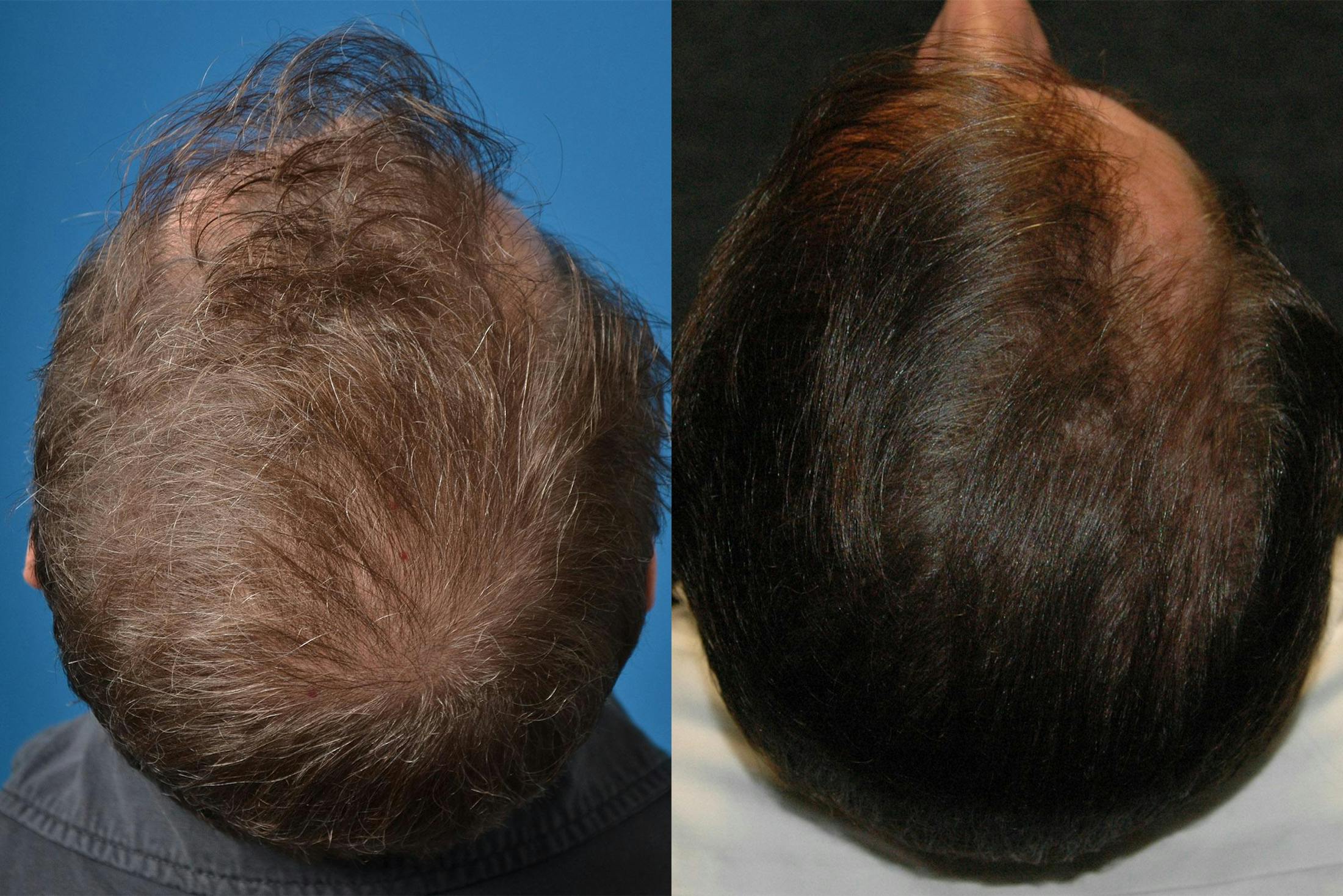 Hair Restoration Before & After Gallery - Patient 122405276 - Image 3