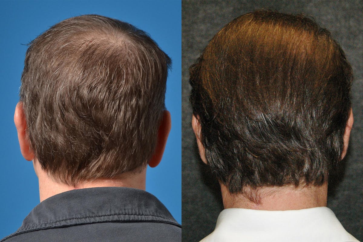 Hair Restoration Before & After Gallery - Patient 122405276 - Image 4