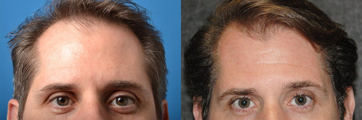 Hair Restoration Before & After Gallery - Patient 122405276 - Image 5