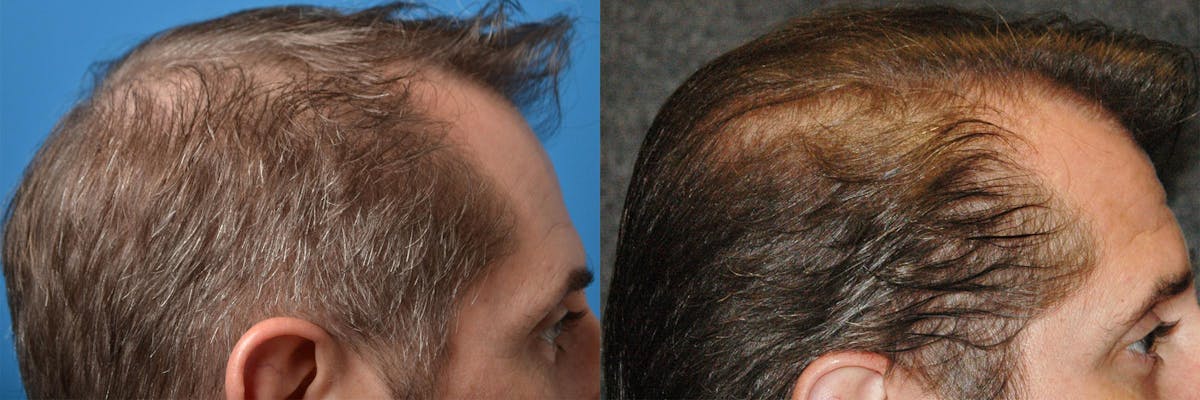 Hair Restoration Before & After Gallery - Patient 122405276 - Image 6