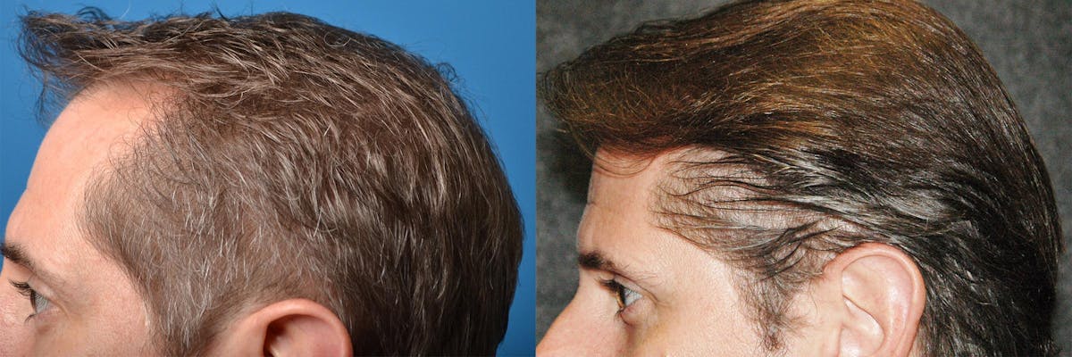 Hair Restoration Before & After Gallery - Patient 122405276 - Image 7