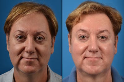 Hair Restoration Before & After Gallery - Patient 122405278 - Image 1