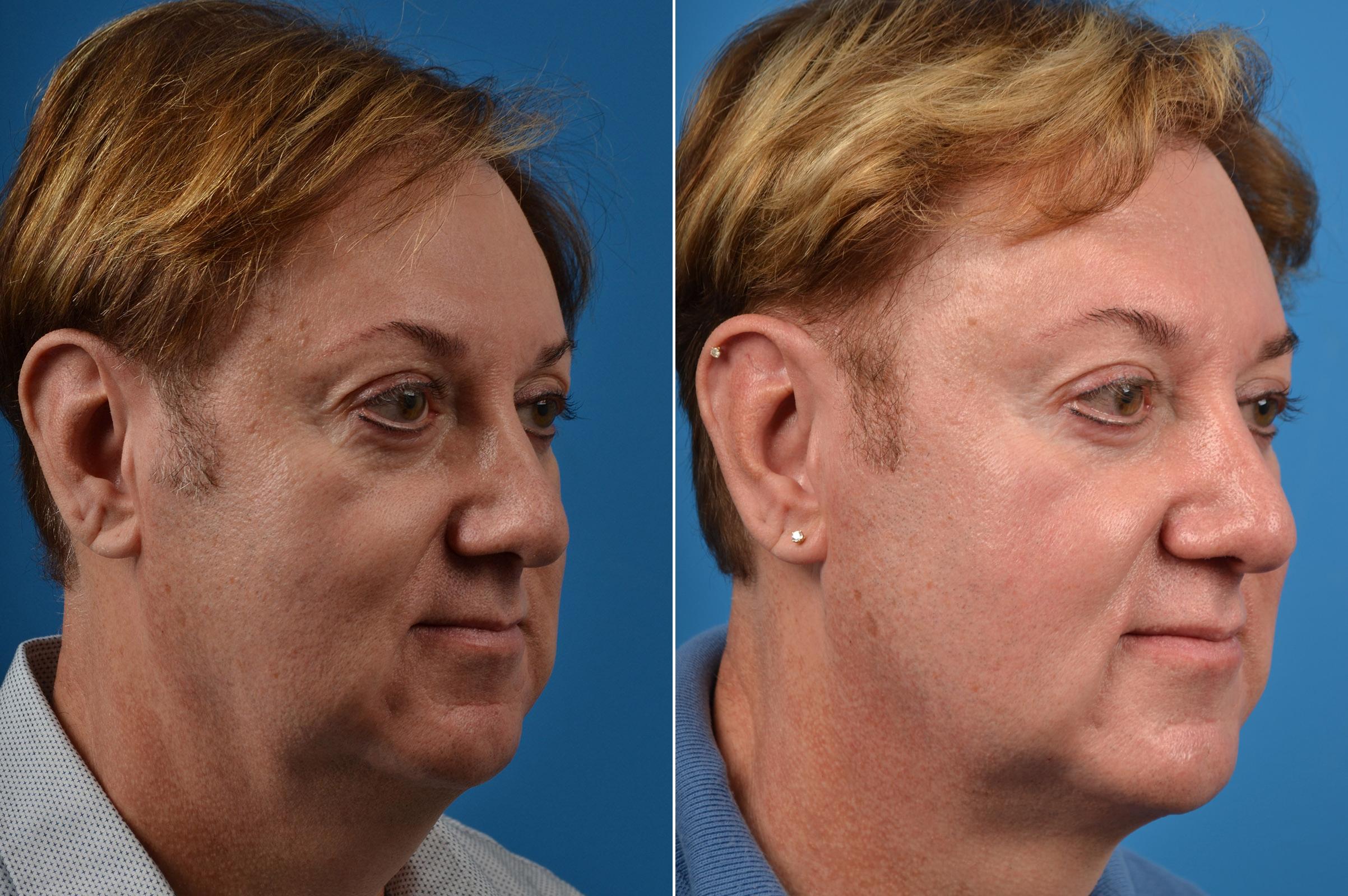 Hair Restoration Before & After Gallery - Patient 122405278 - Image 2