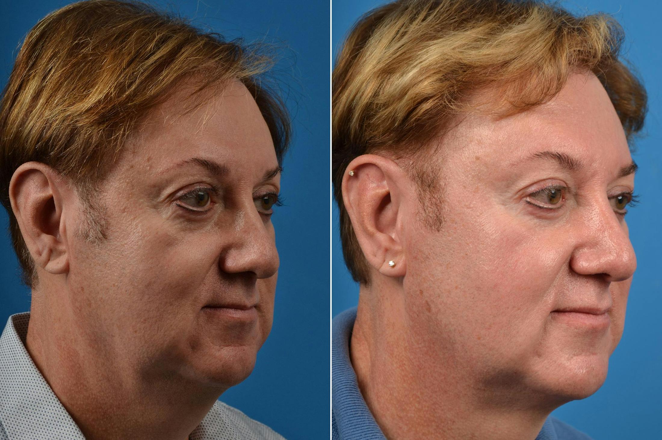 Hair Restoration Before & After Gallery - Patient 122405278 - Image 2