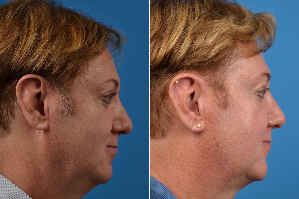 Hair Restoration Before & After Gallery - Patient 122405278 - Image 3