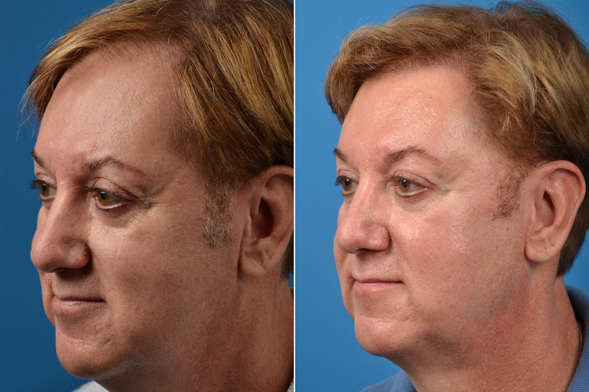 Hair Restoration Before & After Gallery - Patient 122405278 - Image 4