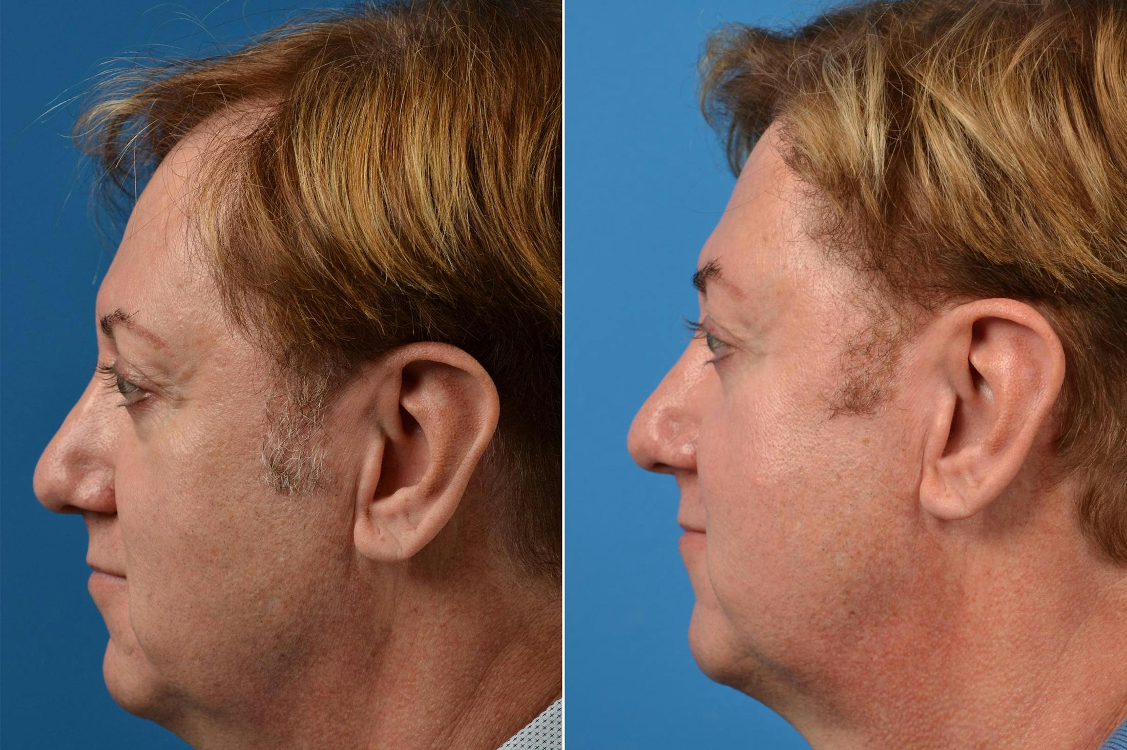 Hair Restoration Before & After Gallery - Patient 122405278 - Image 5