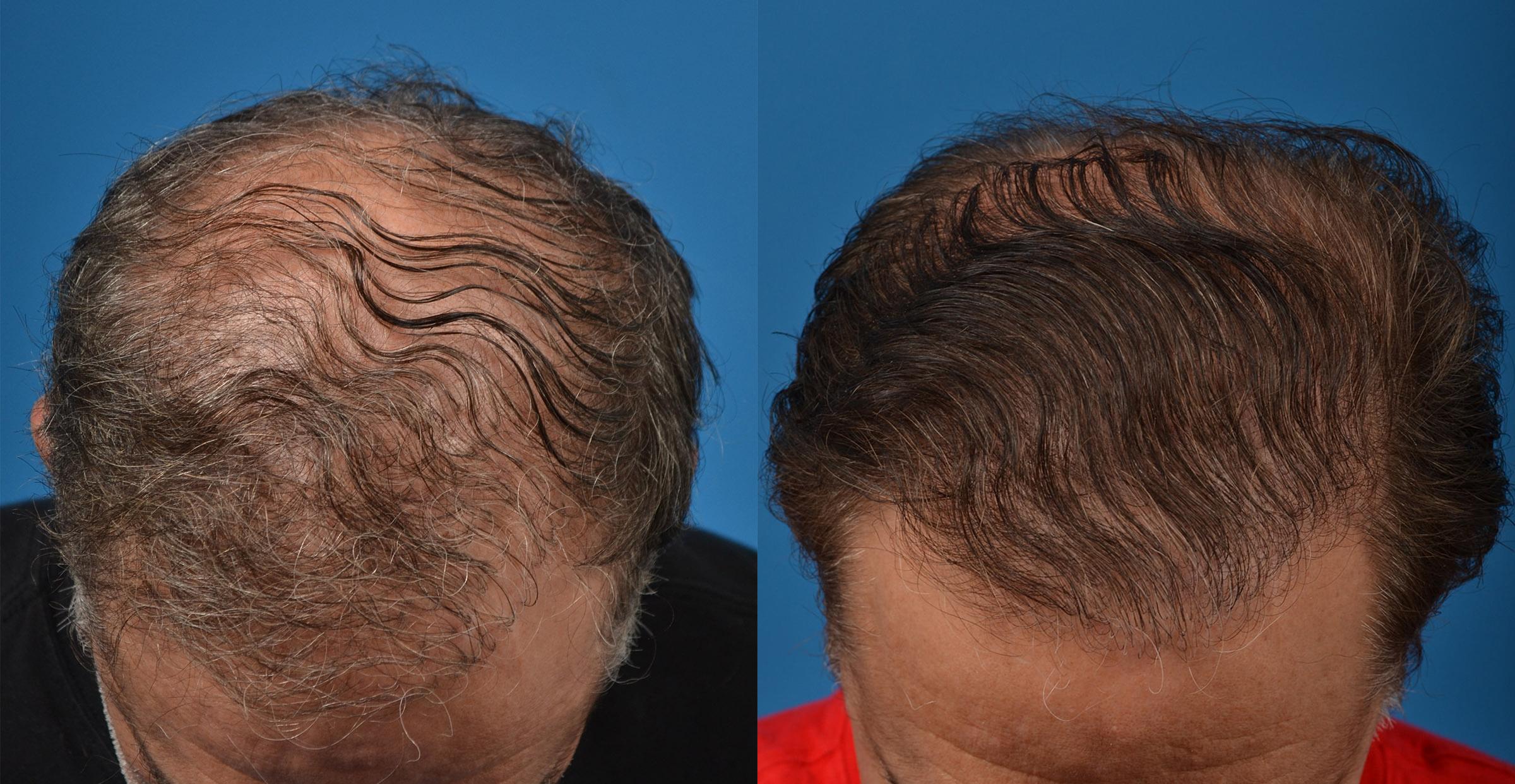 Hair Restoration Before & After Gallery - Patient 122405279 - Image 1