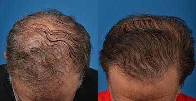 Hair Restoration Before & After Gallery - Patient 122405279 - Image 1