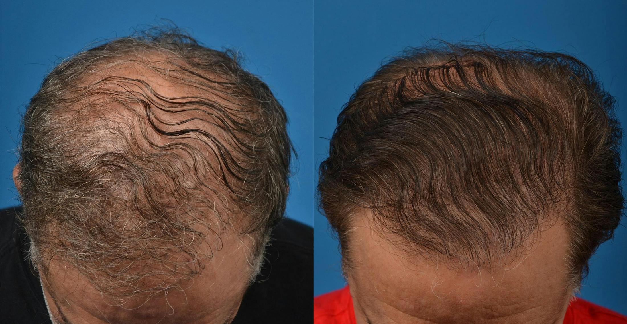 Hair Restoration Before & After Gallery - Patient 122405279 - Image 1