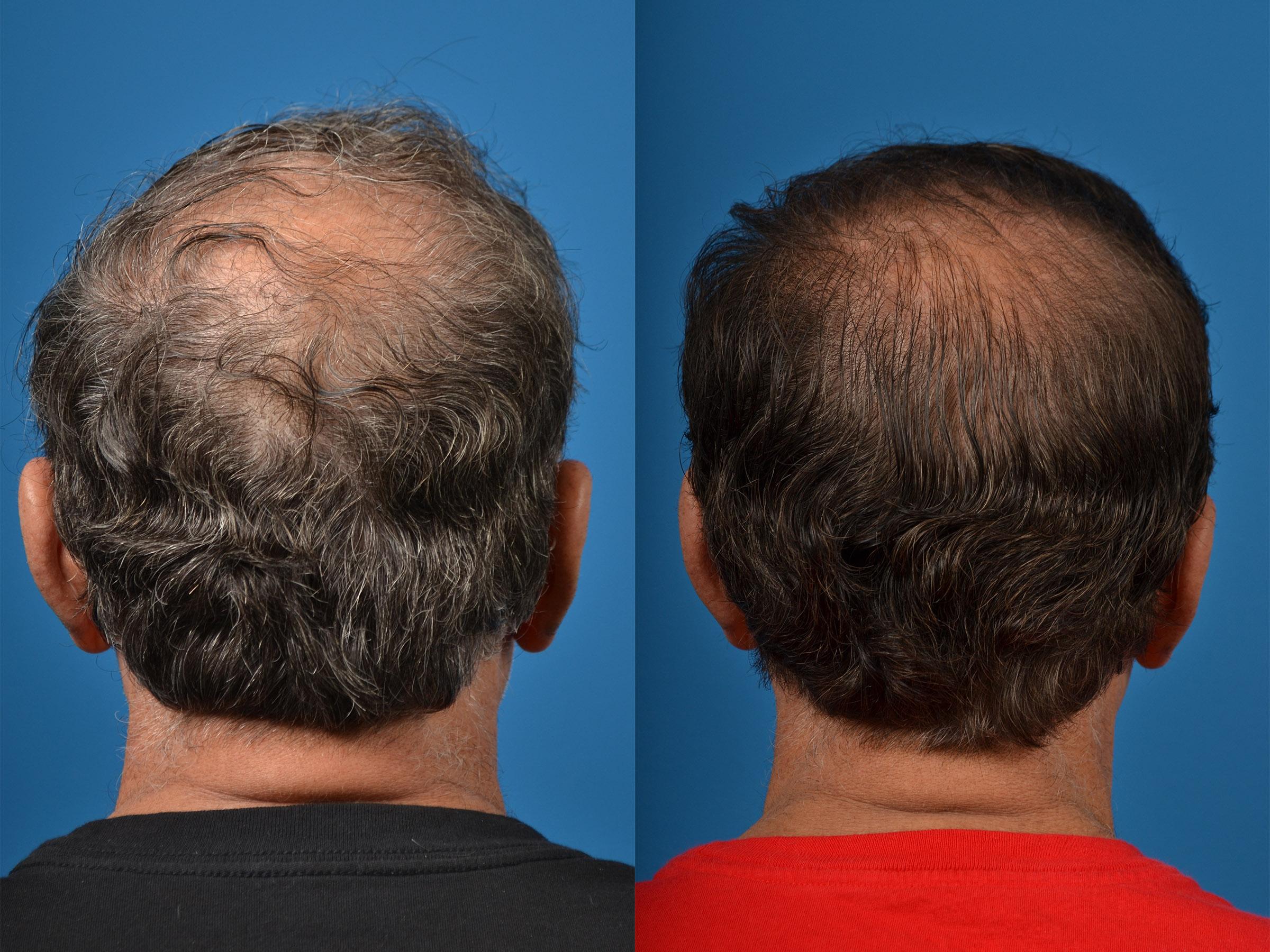 Hair Restoration Before & After Gallery - Patient 122405279 - Image 2