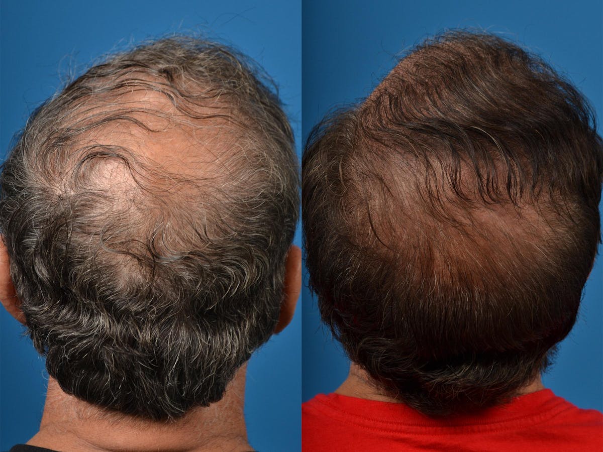 Hair Restoration Before & After Gallery - Patient 122405279 - Image 3