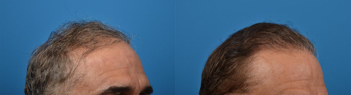 Hair Restoration Before & After Gallery - Patient 122405279 - Image 4