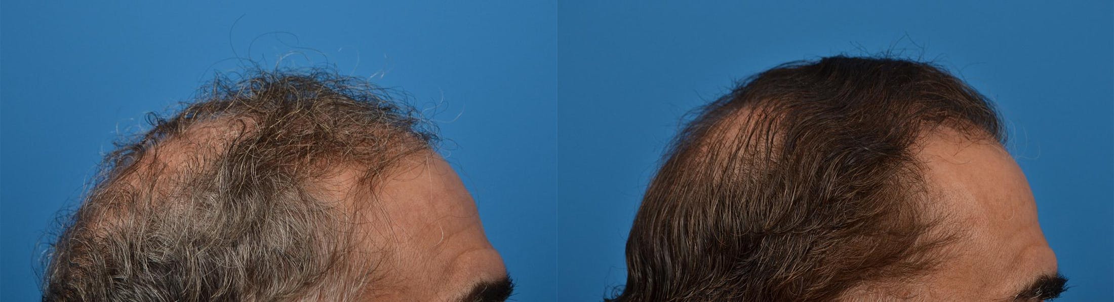 Hair Restoration Before & After Gallery - Patient 122405279 - Image 5