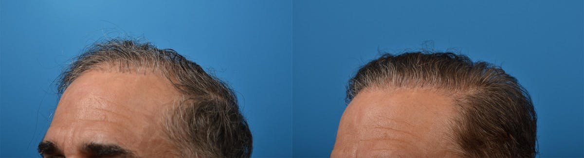 Hair Restoration Before & After Gallery - Patient 122405279 - Image 6