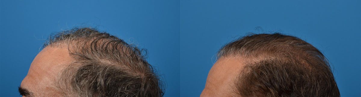Hair Restoration Before & After Gallery - Patient 122405279 - Image 7