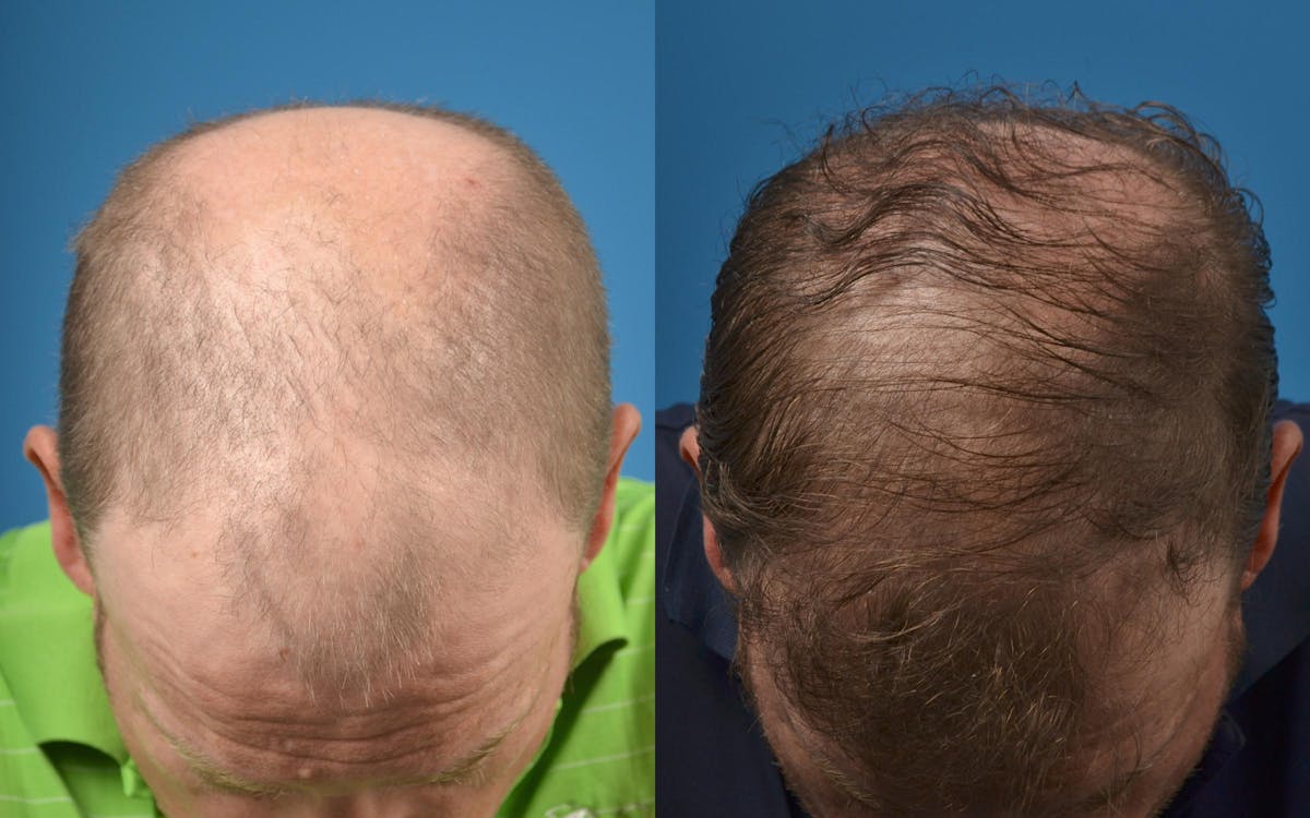 Hair Restoration Before & After Gallery - Patient 122405280 - Image 1