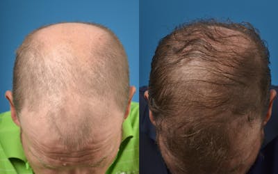 Hair Restoration Before & After Gallery - Patient 122405280 - Image 1