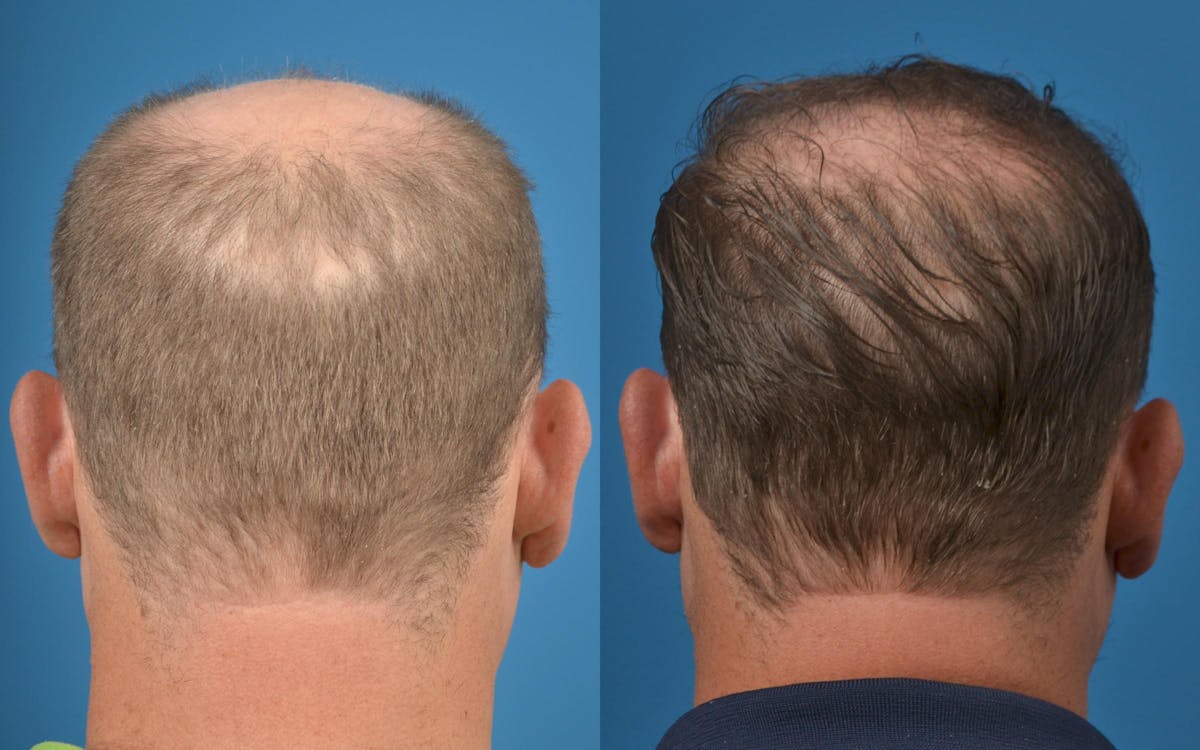 Hair Restoration Before & After Gallery - Patient 122405280 - Image 2