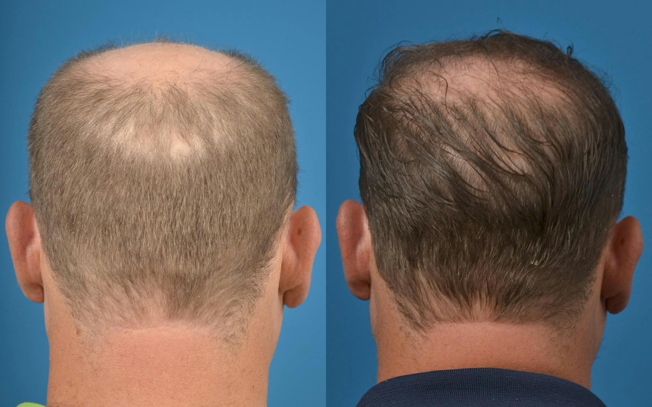 Hair Restoration Before & After Gallery - Patient 122405280 - Image 2